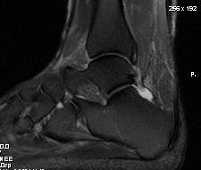 Ankle Retrocalcaneal Bursa